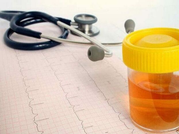 analiza urina za diagnosticiranje cistitisa